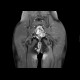 Perianal fistulae, Crohn's disease: MRI - Magnetic Resonance Imaging
